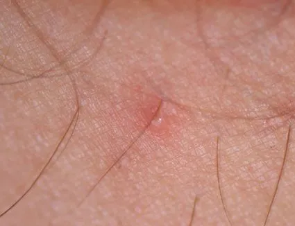 15183 first aid for tarantula wasp bite